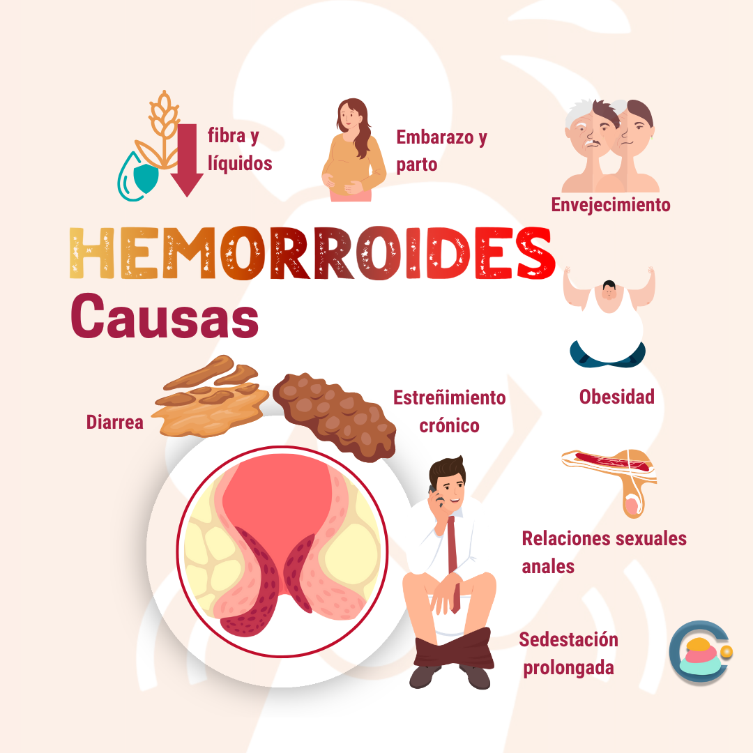 Causas de las Hemorroides Por qué se producen