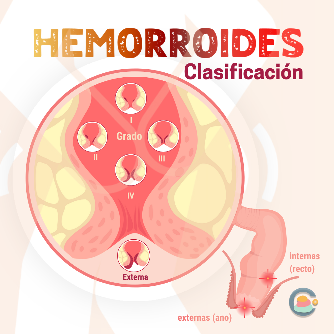 Clasificación y tipos de Hemorroides 