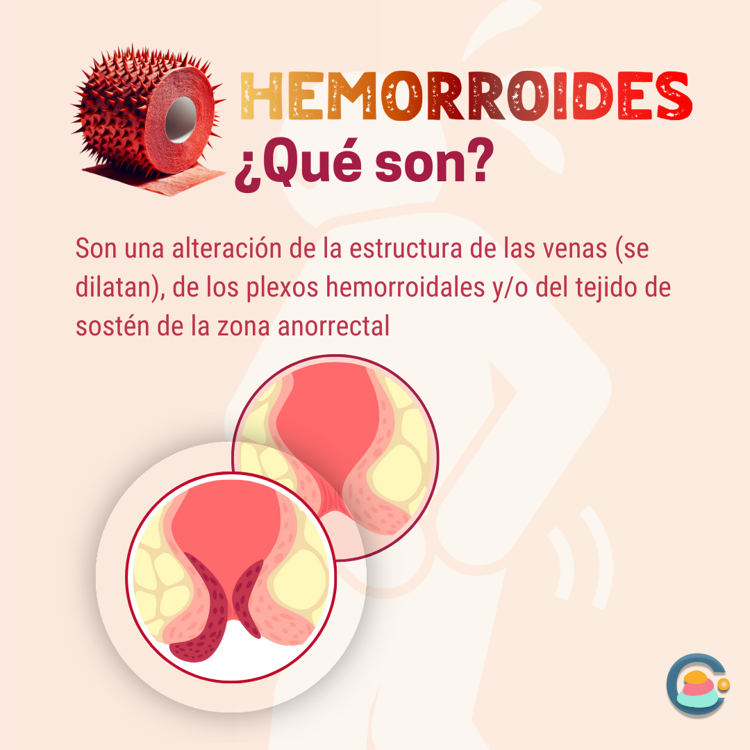 Hemorroides qué son